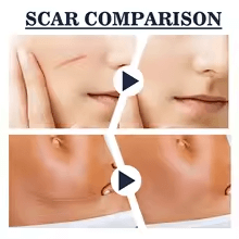 Comparison of skin appearance with scars before and after using Spray ricostituente.